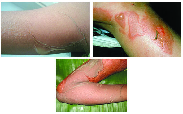 درمان كودكي با سندرم (4S)  Staphylococcal Scalded Skin Syndrome (SSSS)